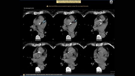 CT Calcium Automated Analysis¹