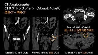case 84
造影剤量低減
下肢動脈CT-Angiography
