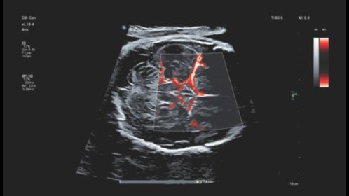Fetal circle of Willis with MFI HD