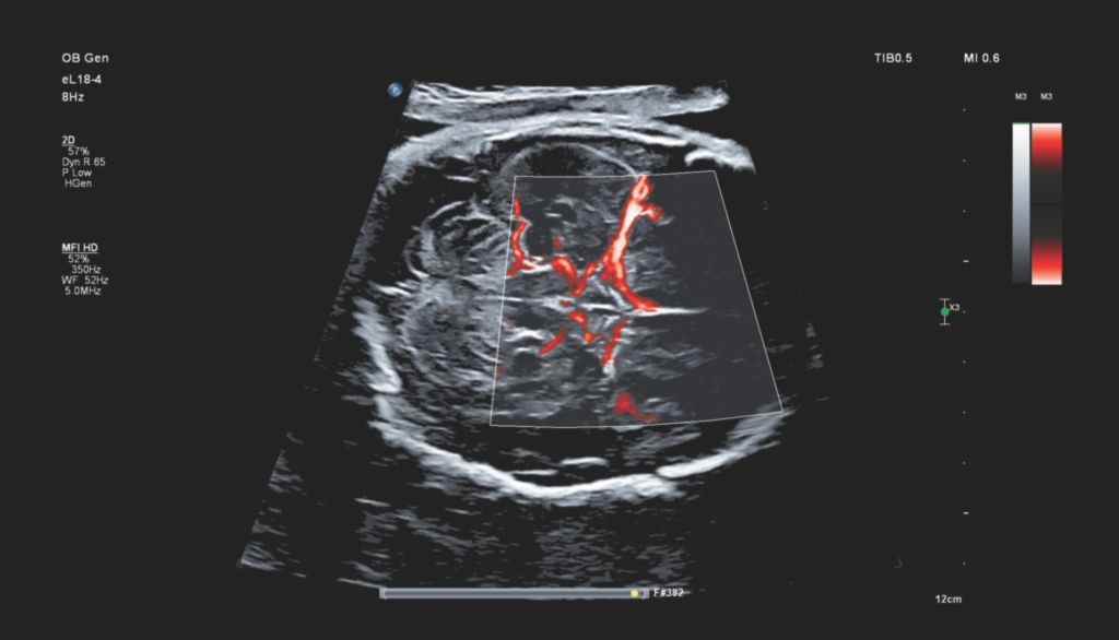 Fetal circle of Willis with MFI HD