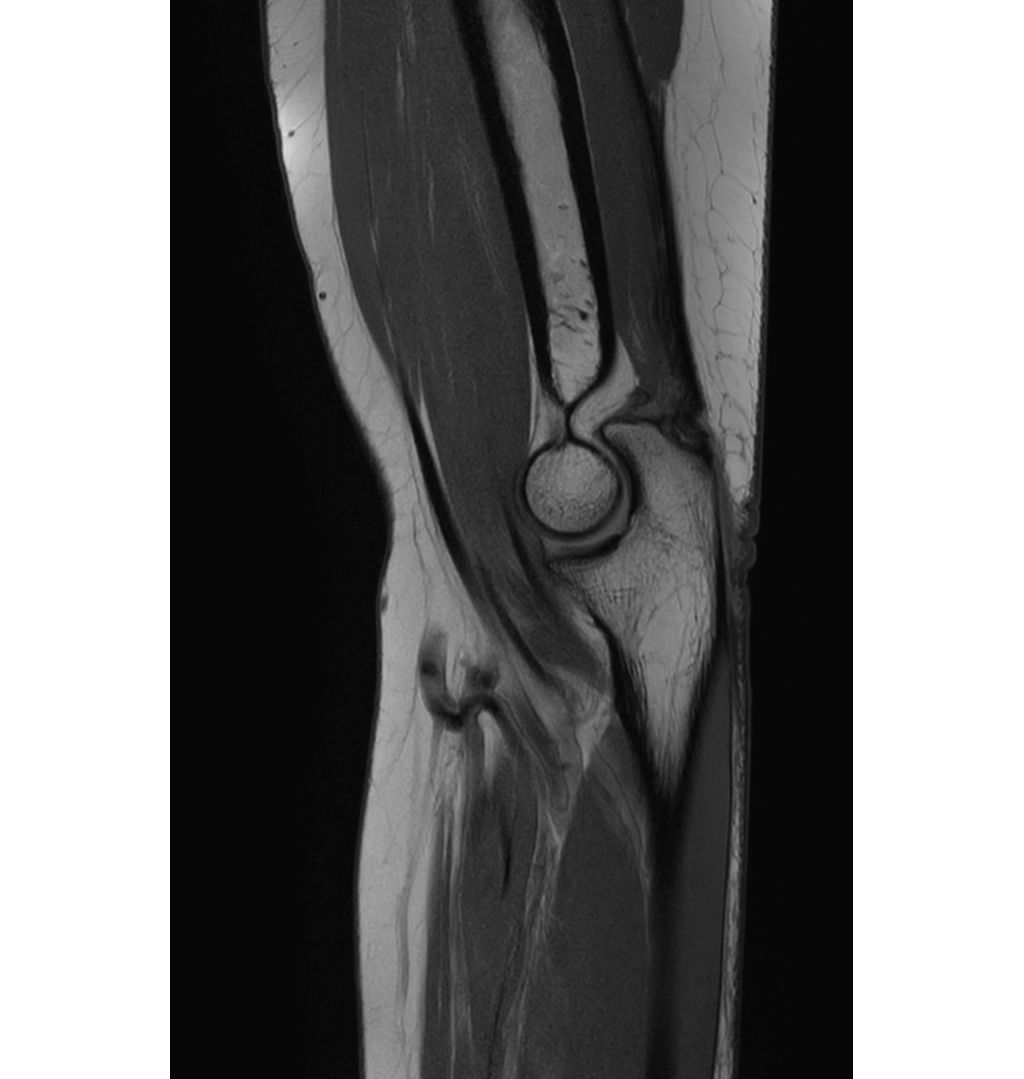 Sagittal PDw TSE