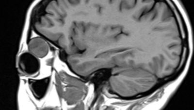 Imagen por resonancia magnética para apoyar la planificación de un tratamiento neurointervencionista