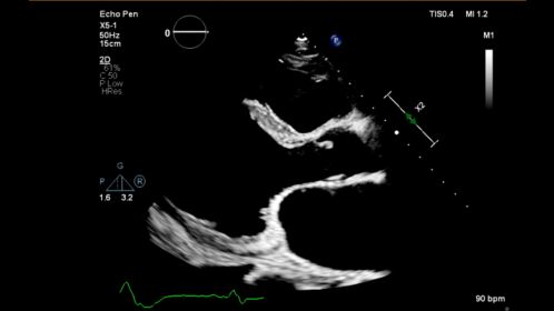 Affiniti CVx X5-1 PLAX Dilated LV and LA
