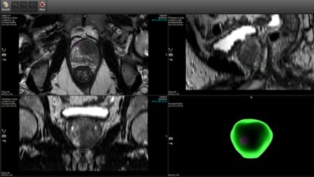 Boost confidence for biopsies