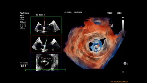 Live 3D TEE Glass of Mitral Valve Clip CV Ultrasound Imaging