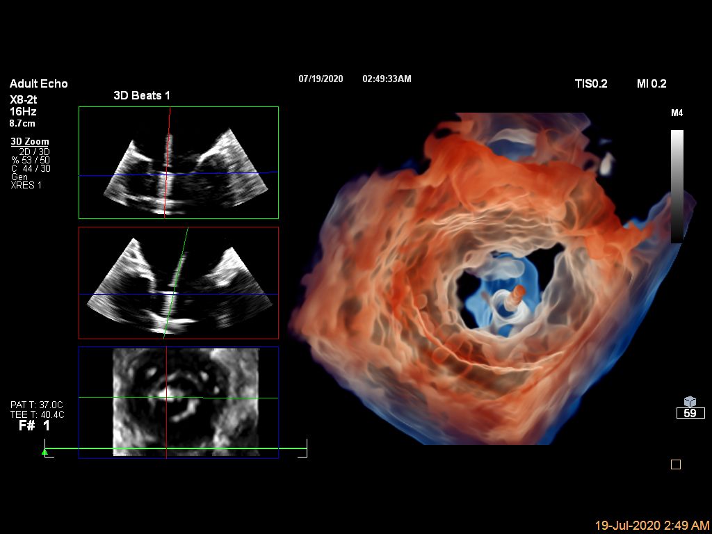 Live 3D TEE Glass of Mitral Valve Clip CV Ultrasound Imaging