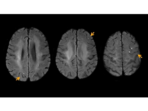 SmartSpeed Diffusion - Brain Aplicaciones clínicas para RM