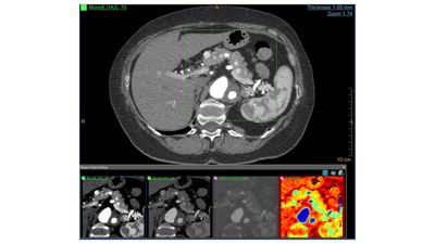 Philips IQon Spectral CT — Клинические исследования на IQon Spectral CT — фото 4