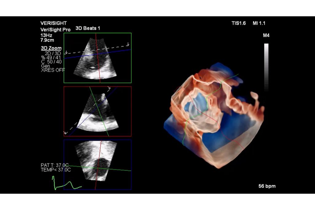 3D imaging of a left atrial appendage (LAA) with TrueVue and MultiVue