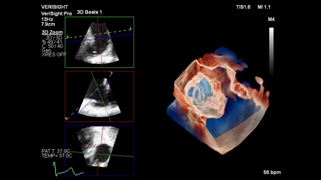 3D imaging of a left atrial appendage (LAA) with TrueVue and MultiVue