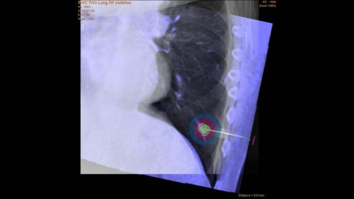 Kidney Cryo Post-ablation XperCT showing ice-ball extent and complete tumor coverage.