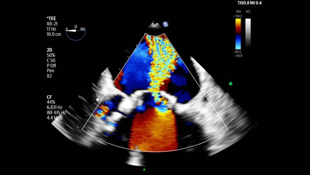 Adult echo with mitral regurgitation shown with color using X8-2t transducer.
