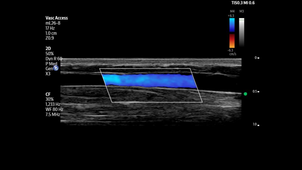 Pediatric antecubital shown using color with mL26-8 transducer.