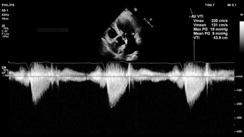 Auto Measure shown using S5-1 transducer