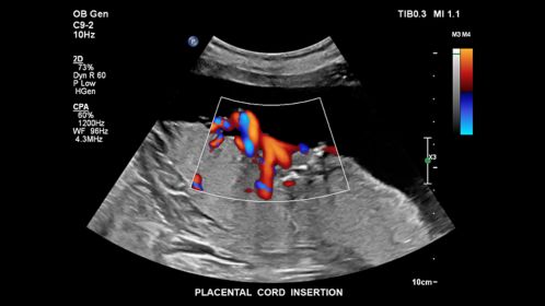 Placental cord insertion