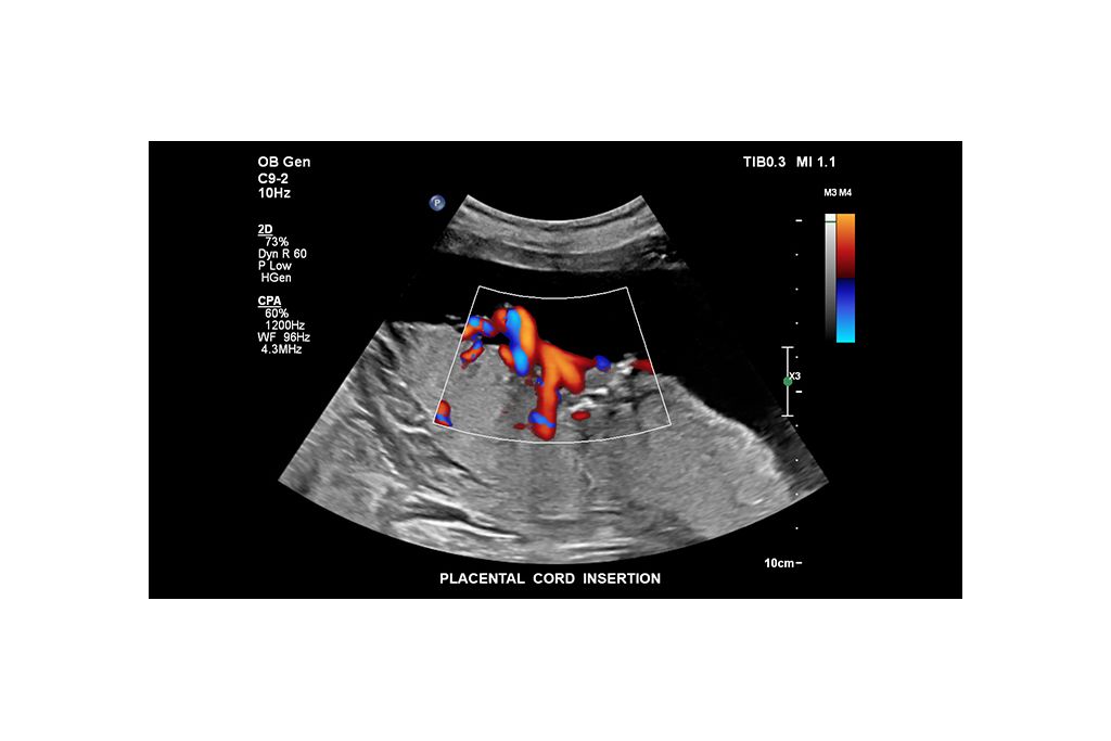 Placental cord insertion