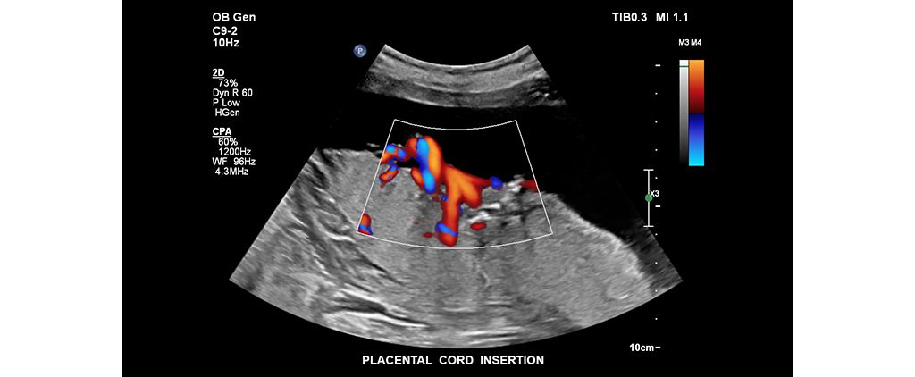 Placental cord insertion