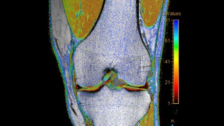 Cartilage assessment