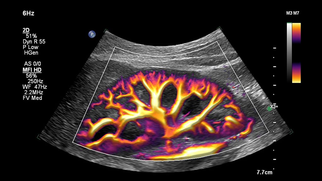 Clinical image using EPIQ Elite and C5-1 transducer showing kidney with MFI HD  