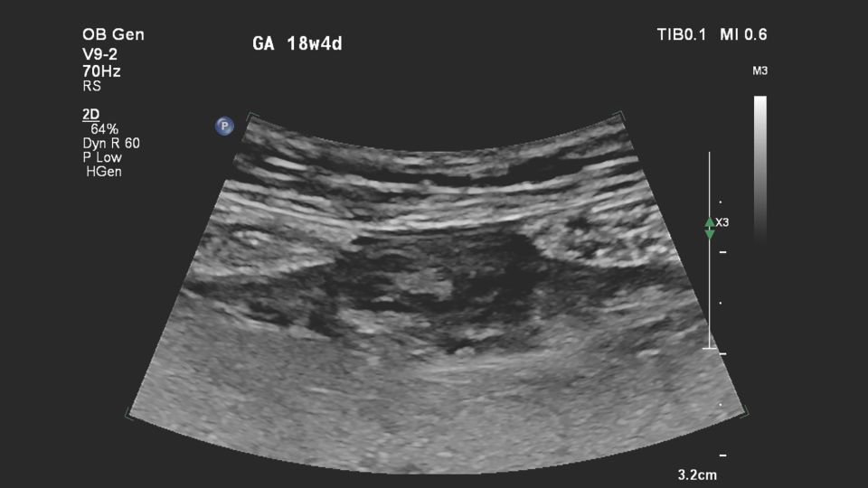 V9-2 transducer sagittal close-up of suspected placental abnormality