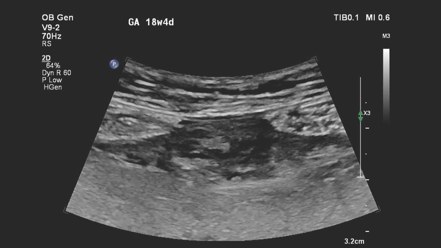 V9-2 transducer sagittal close-up of suspected placental abnormality