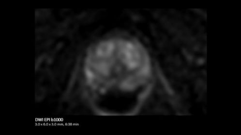 Prostate DWI EPI b1000