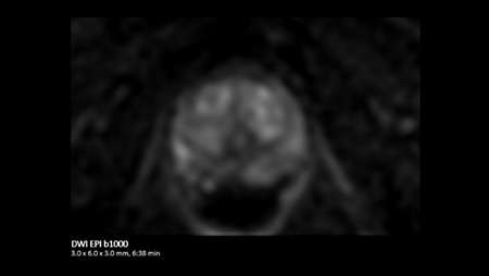 Prostate DWI EPI b1000