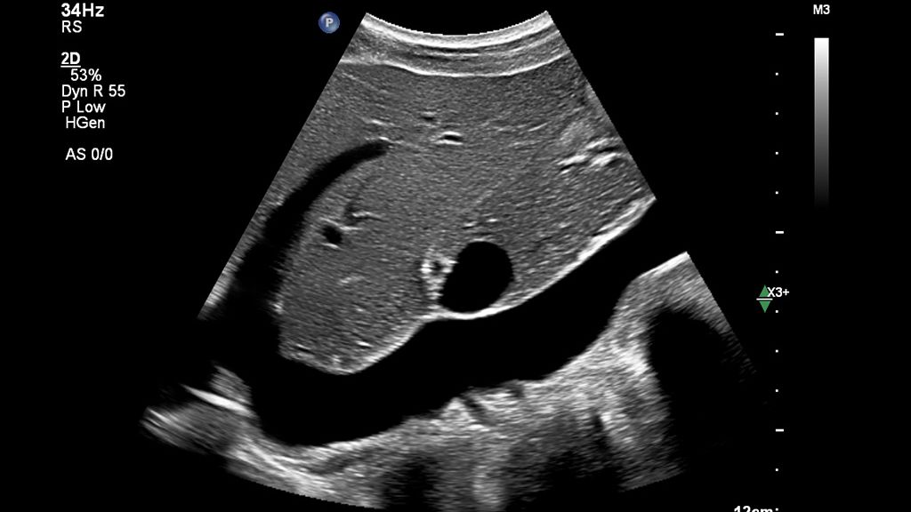Clinical image using EPIQ Elite and C5-1 transducer showing abdomen vascular and 2D liver 