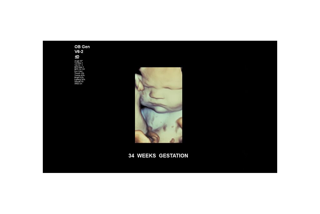 Fetal face at 34 weeks gestation.