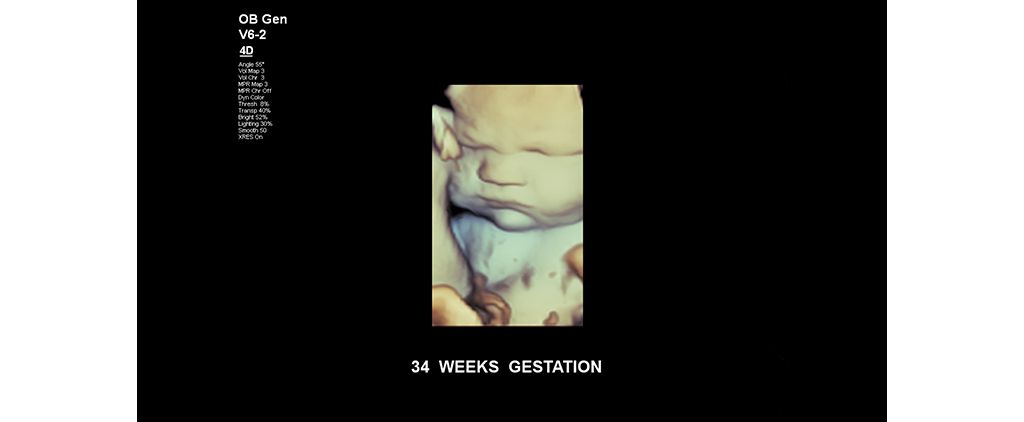 Fetal face at 34 weeks gestation.