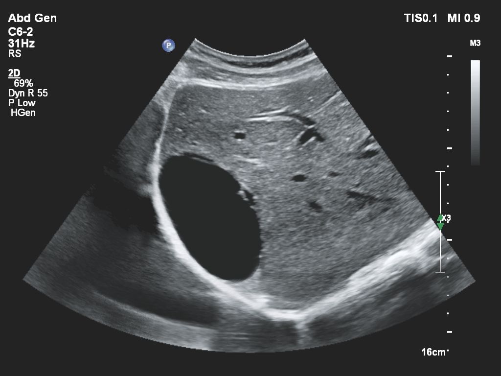 Affiniti 30 ultrasound clinical image abdomen