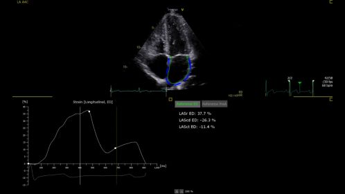 Ultrasound Workspace AutoStrain LA