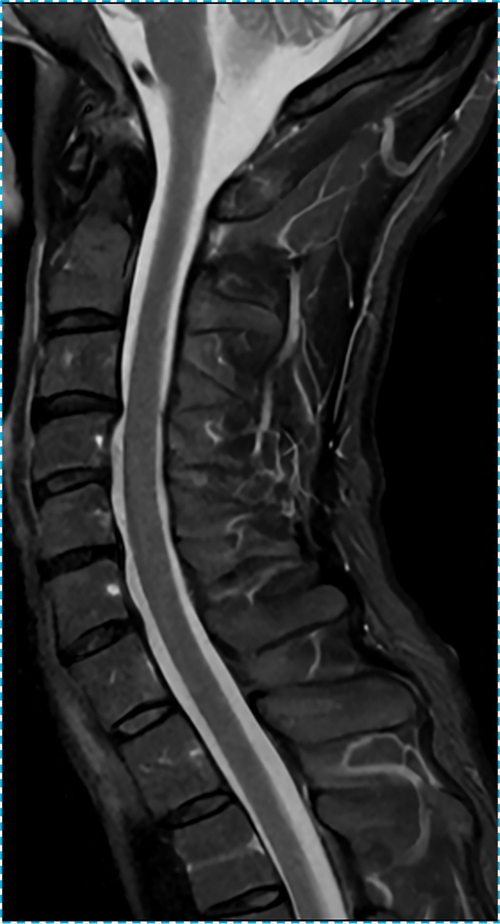 C Spine STIR