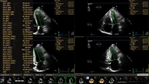 Ultrasound Workspace Cardiac Measurement