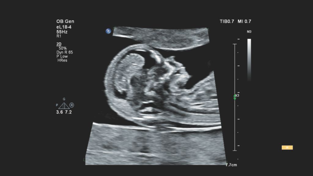 EPIQ Elite fetal profile shown using the eL18-4
