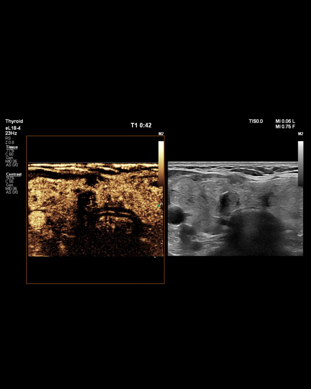 A clinical image of a thyroid during a CEUS exam