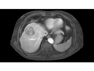 4D FreeBreathing MR clinical application