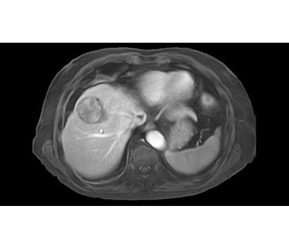 Philips 4D FreeBreathing clinical application