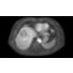 Philips 4D FreeBreathing clinical application thumbnail