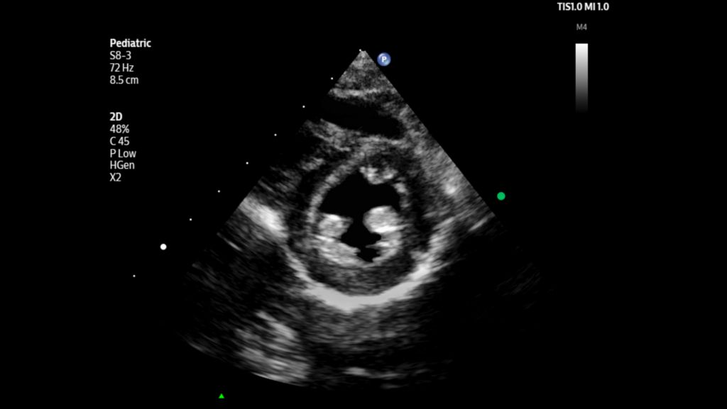 Pediatric parasternal short axis view of left ventricle shown using S8-3 transducer.