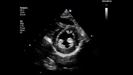 Pediatric parasternal short axis view of left ventricle shown using S8-3 transducer.