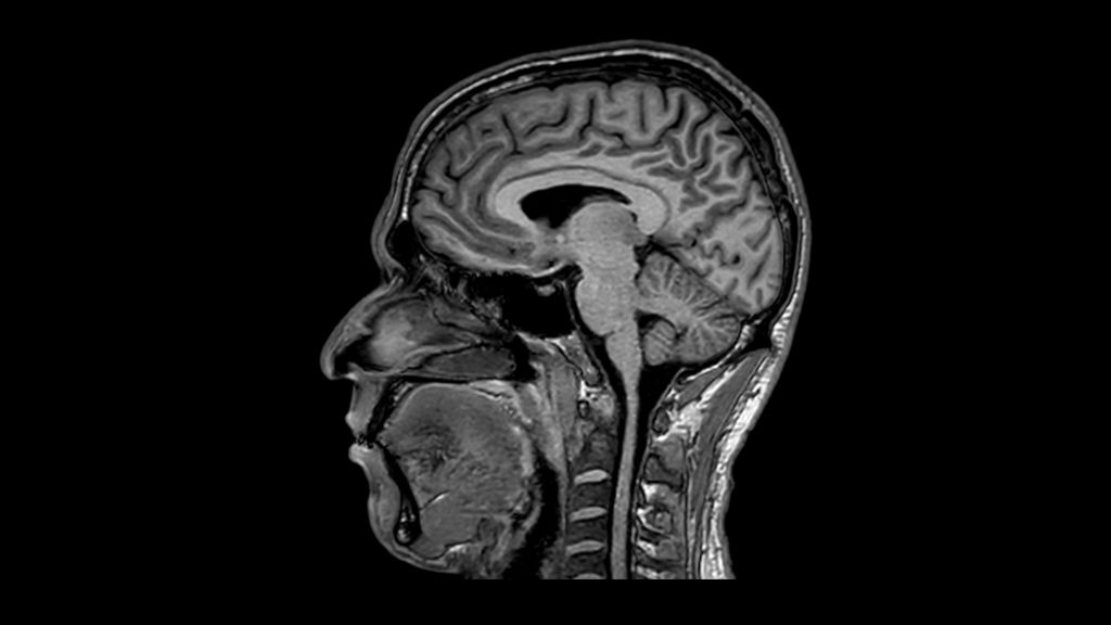 3D T1w TFE (MPRAGE) clinical image of the brain
