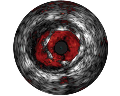 Philips Visions Peripheral .018 Digital IVUS catheter