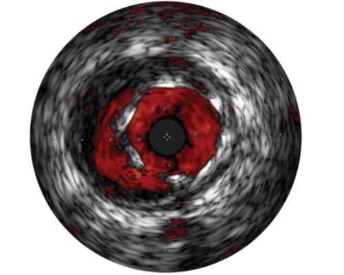 IVUS, a catheter-based imaging technology