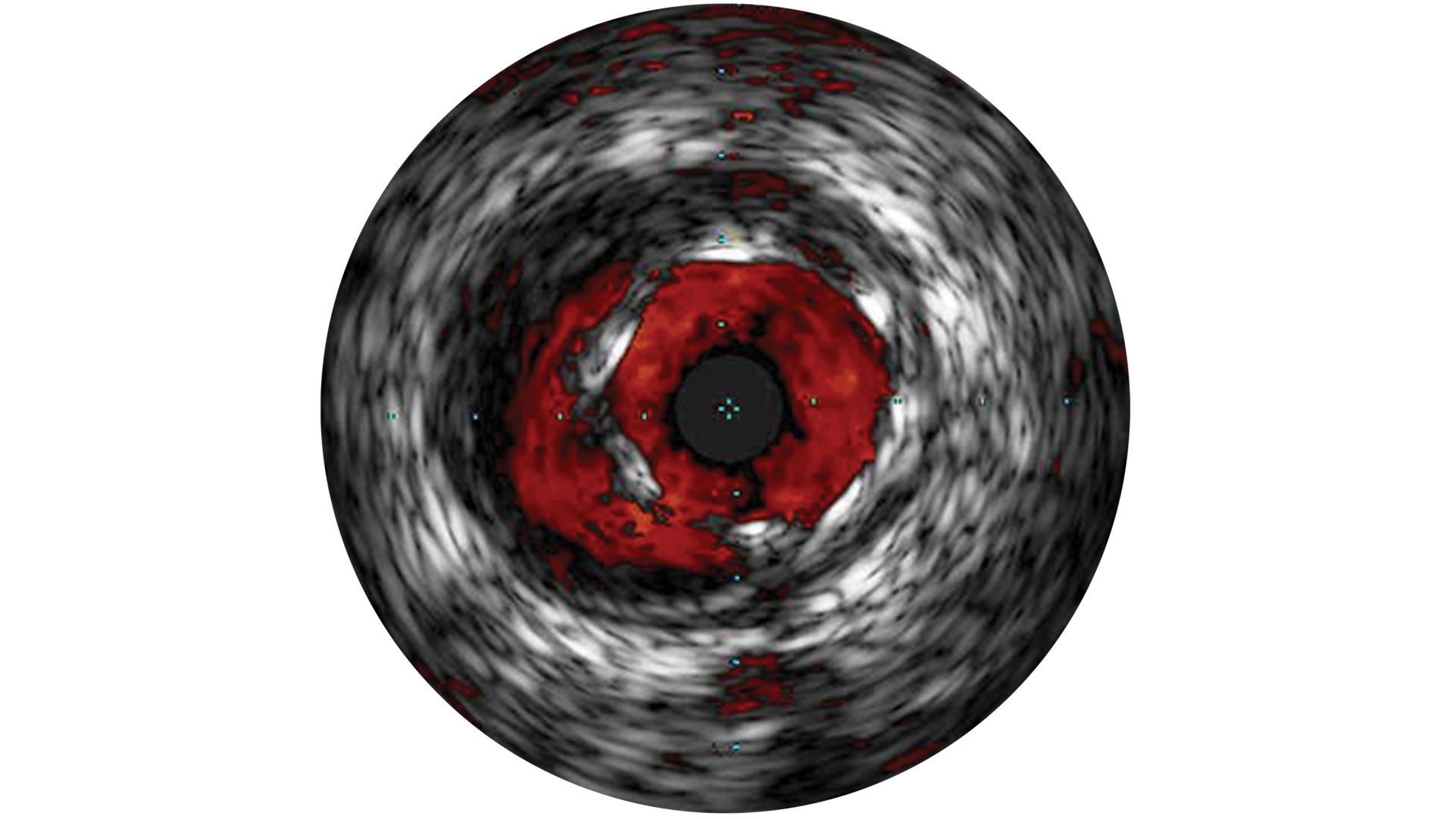 Image of IVUS with Chromaflo