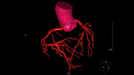 New robust automatic coronary tree extraction and labeling ​