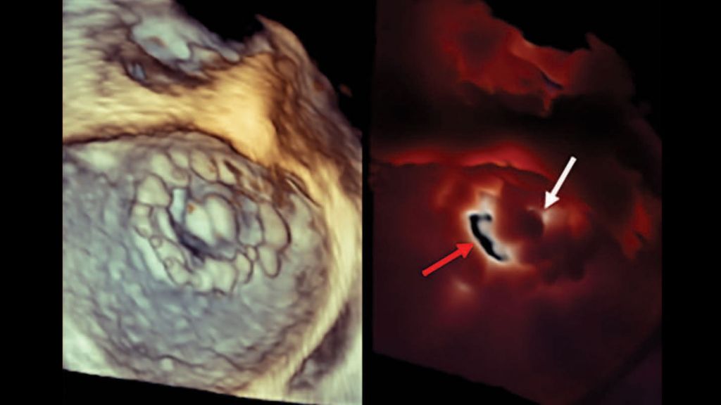 Clinical image – TrueVue - Transillumination aids in identifying an obstructive mitral valve prosthesis.
