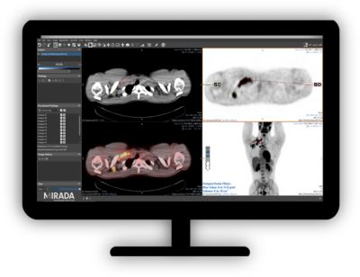 Philips - NM Mirada XD4.2 PET/CT and NM viewing and quantification
