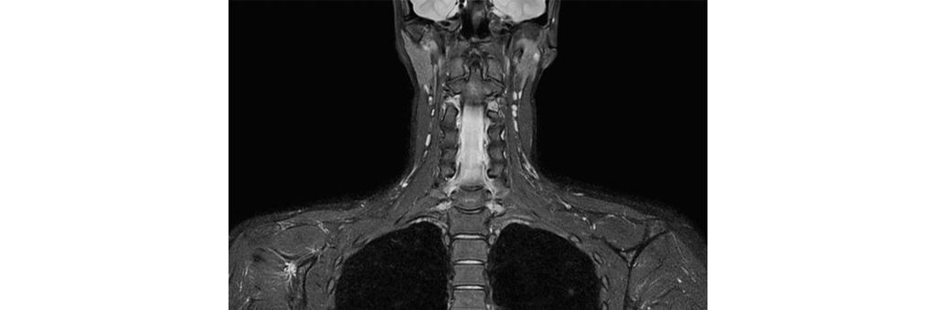 Coronal T2w TSE mDIXON (Water only) - HeadNeck