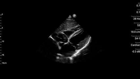 Subcostal four chamber cardiac view shown using S4-1 transducer.